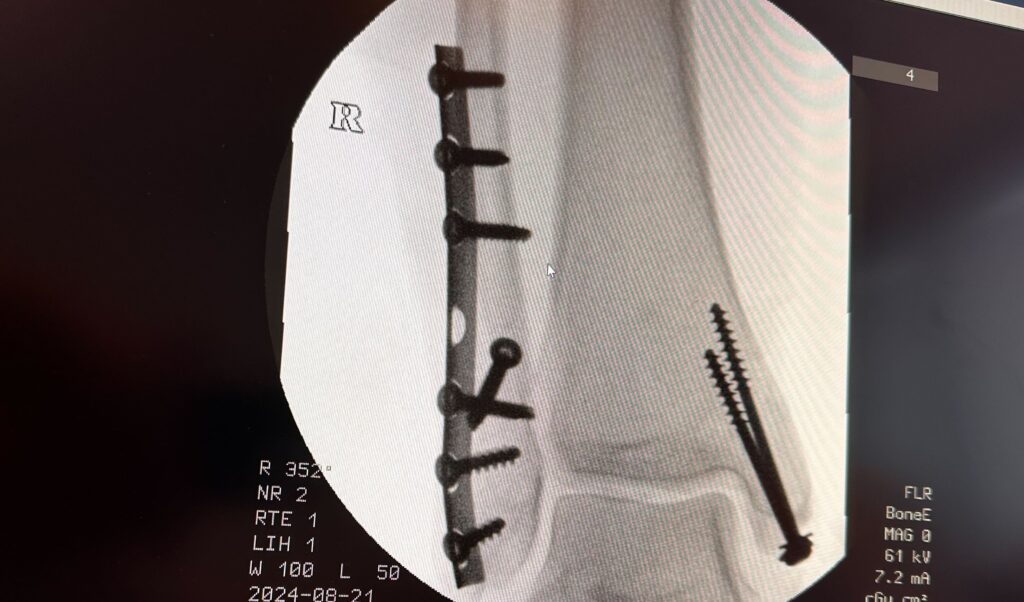 xray image of a broken ankle that is fixated by screws